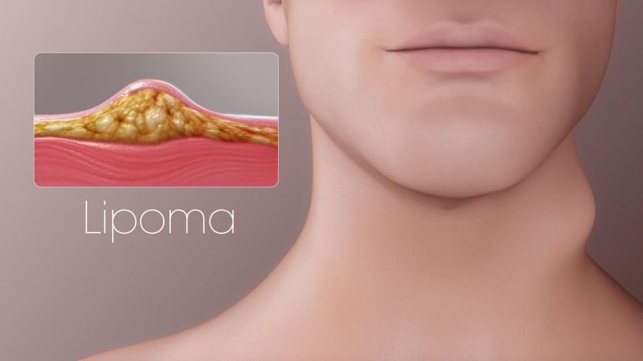 Lipoma