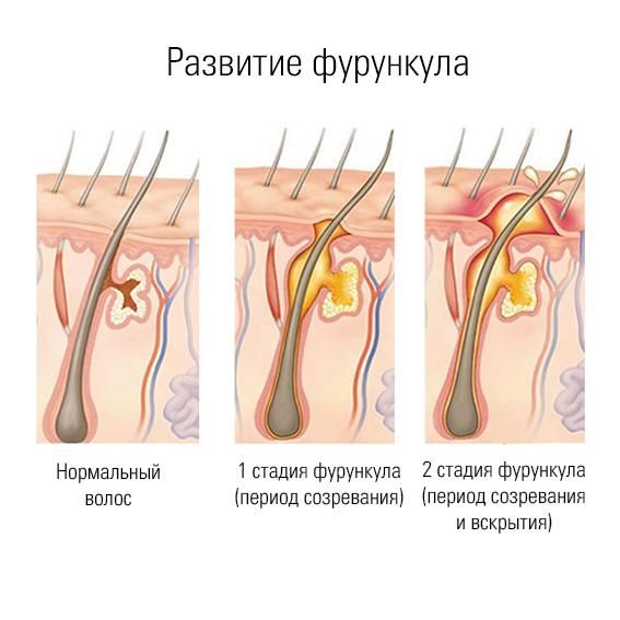 Фурункулы и карбункулы - Дерматологическая патология - Справочник MSD Профессиональная версия