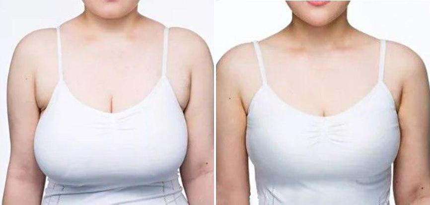 Маммопластика фото до и после 3 размер